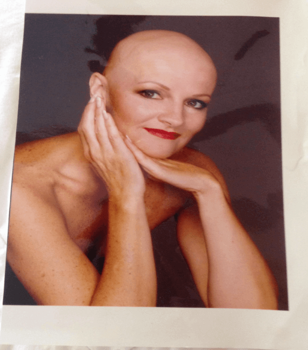 Peggy-knight-owner-of -peggy-knight-wigs-Younger-alopecia-bald